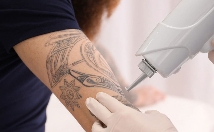 woman with tattoo removal laser