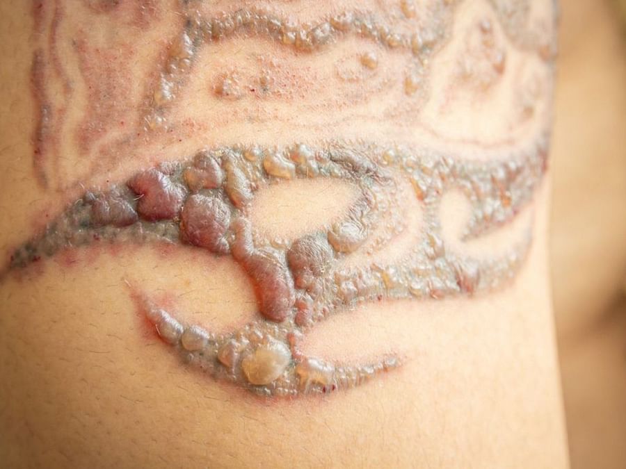 Tattoo removal side effects