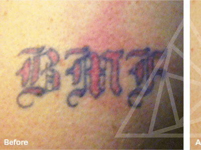 The Art of Tattoo Removal: What You Need to Know Before Erasing Your Ink