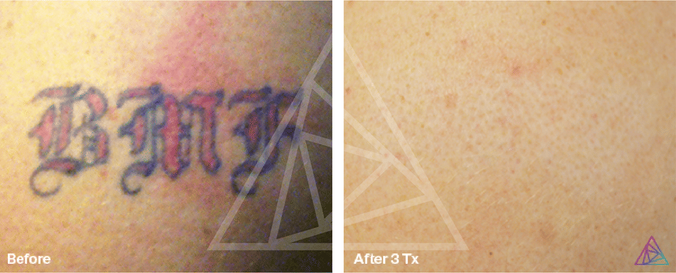 The Art of Tattoo Removal: What You Need to Know Before Erasing Your Ink