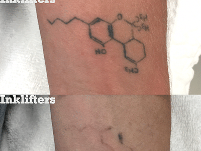Inklifters Tattoo Removal