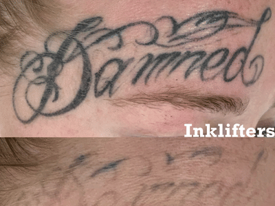 Inklifters Tattoo Removal
