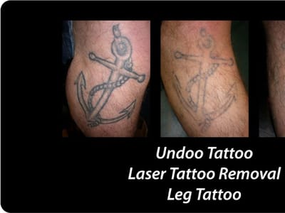 Undoo Tattoo